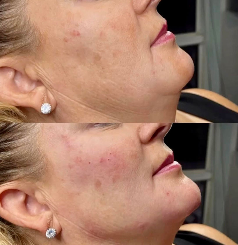 jaw-line-filler-refinement-laser-lounge-estero-19