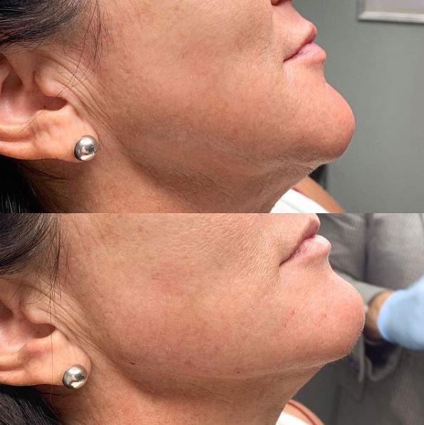 jaw-line-filler-refinement-laser-lounge-estero-20