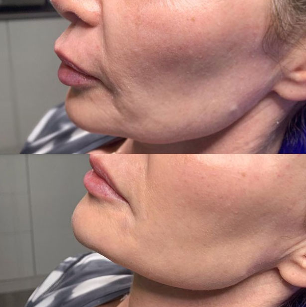 jaw-line-filler-refinement-laser-lounge-estero-21