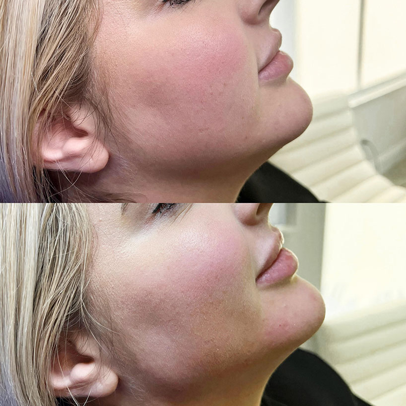 jaw-line-filler-refinement-laser-lounge-estero-22