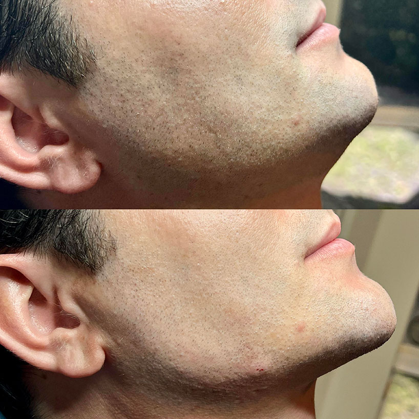 jaw-line-filler-refinement-laser-lounge-estero-23
