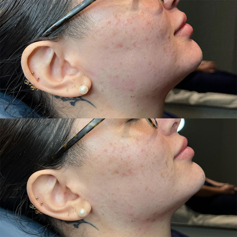 jaw-line-filler-refinement-laser-lounge-estero-24