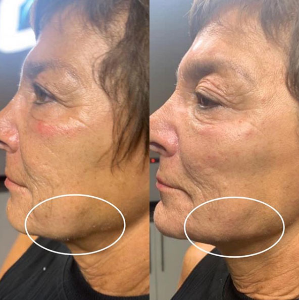 jaw-line-filler-refinement-laser-lounge-estero-7