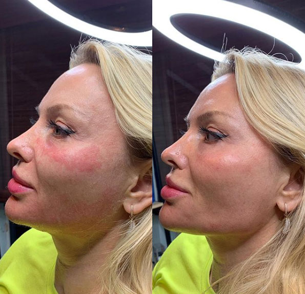 jaw-line-filler-refinement-laser-lounge-estero-8