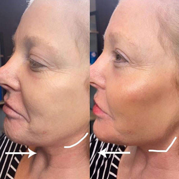jaw-line-filler-refinement-laser-lounge-estero-9