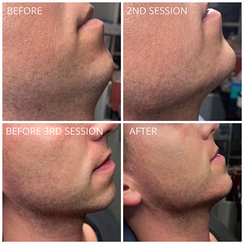kybella-the-laser-lounge-spa-estero-1-before-and-after