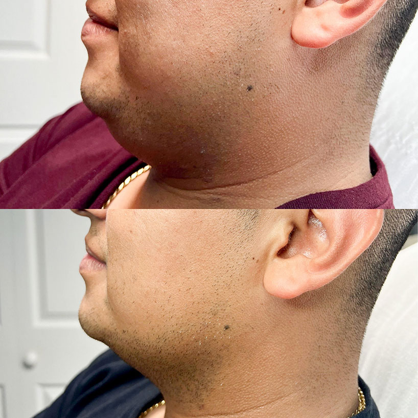 kybella-the-laser-lounge-spa-estero-2-before-and-after