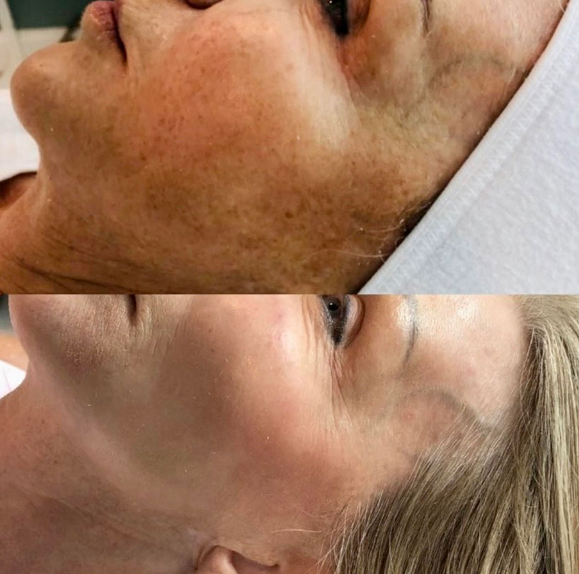 laser-lounge-before-after-ipl-laser-lounge