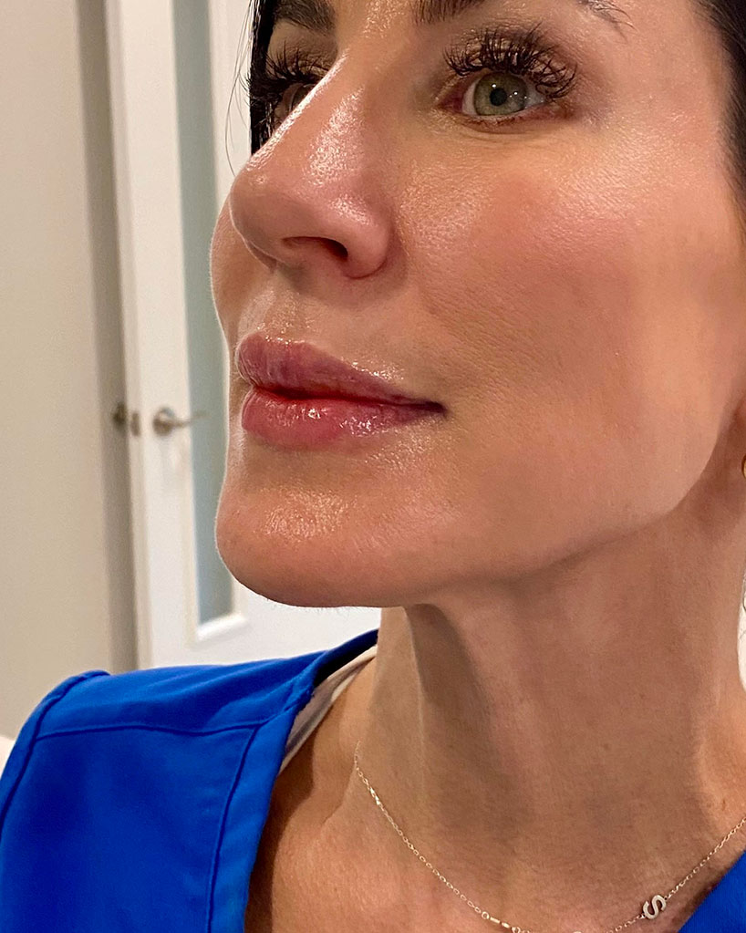 lip-filler-after-laser-lounge-spa-estero-2