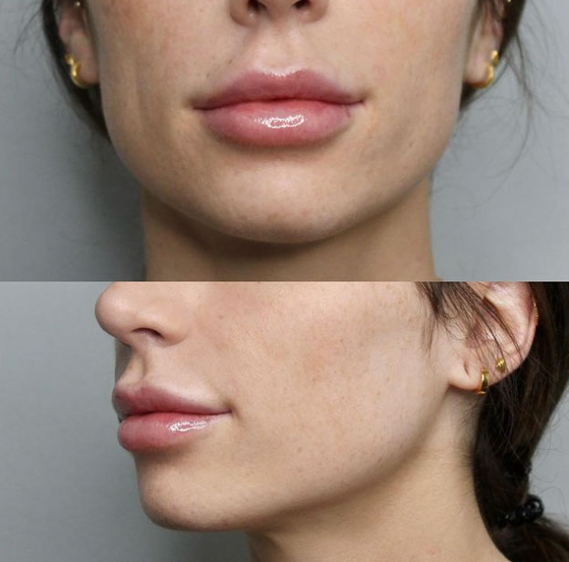 lip-filler-before-after-laser-lounge-spa-estero12