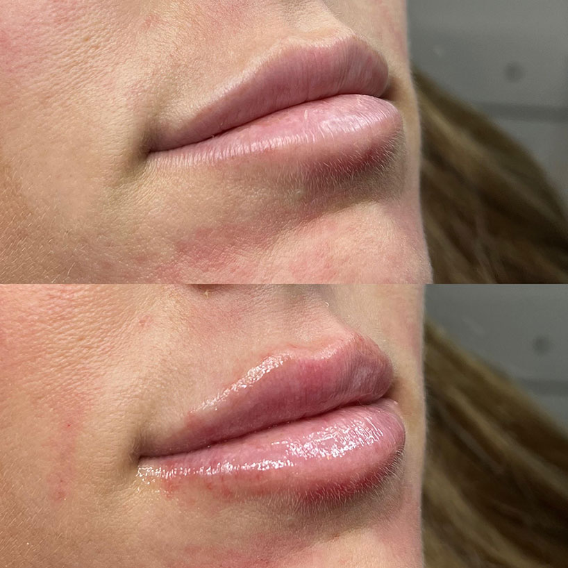 lip-filler-before-after-laser-lounge-spa-estero2