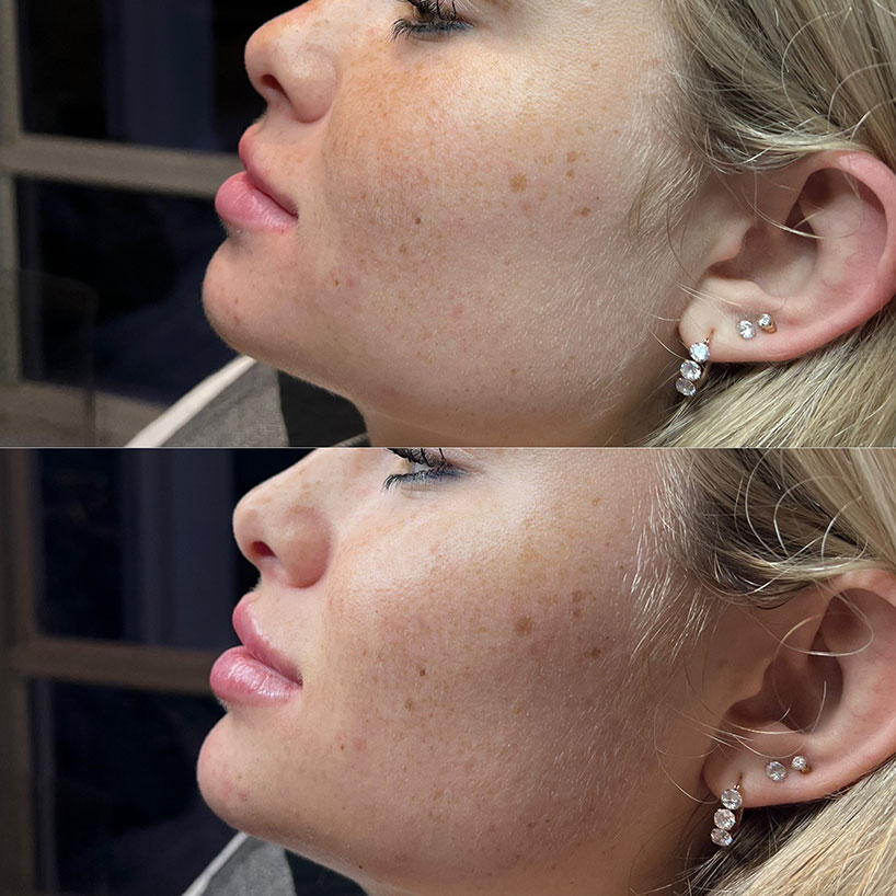 lip-filler-before-after-laser-lounge-spa-estero3