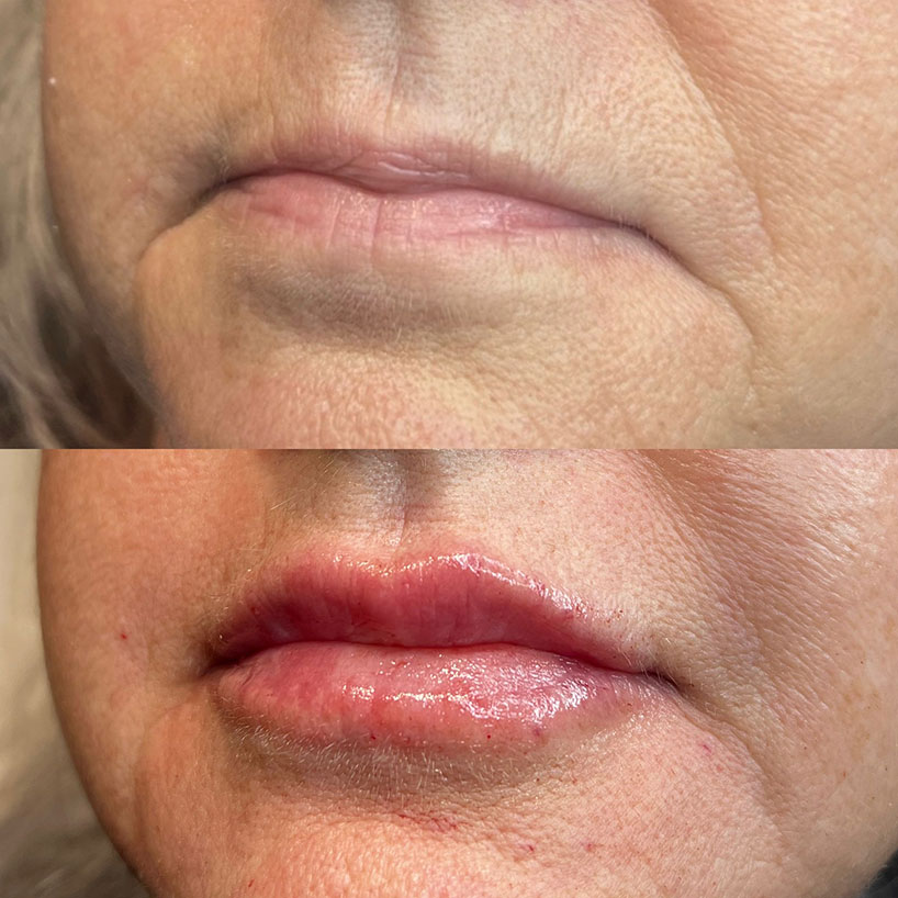lip-filler-before-after-laser-lounge-spa-estero5
