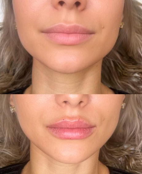 lip-filler-before-after-laser-lounge-spa-estero6