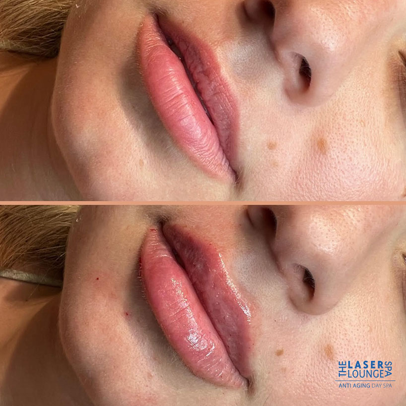 lip-filler-before-after-laser-lounge-spa-estero7