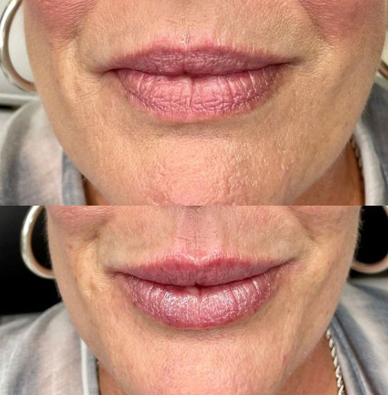 lip-filler-before-after-laser-lounge-spa-estero8