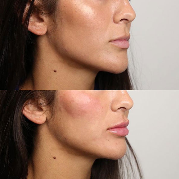 lip-filler-before-after-laser-lounge-spa-estero9