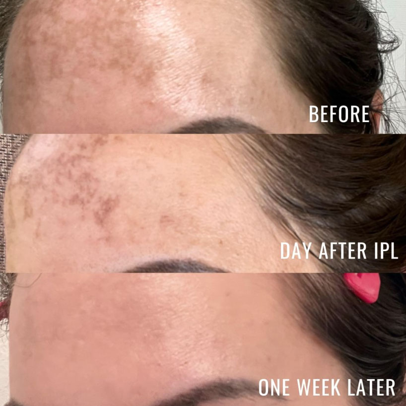 pixel-ipl-laser-lounge-estero-results