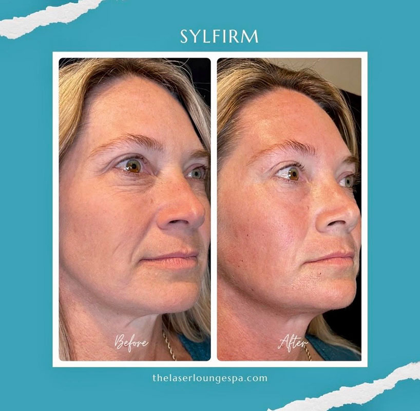 rf-microneedling-laser-lounge-estero-10