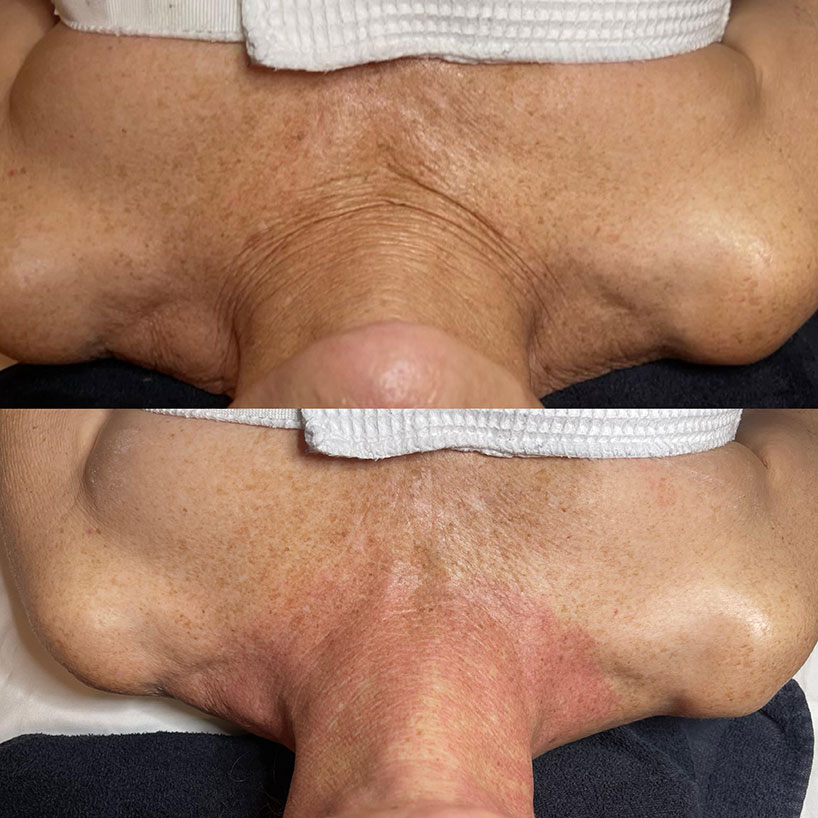 rf-microneedling-laser-lounge-estero-14