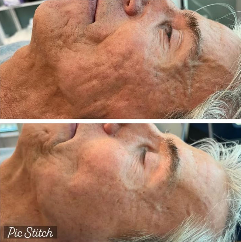 rf-microneedling-laser-lounge-estero-15