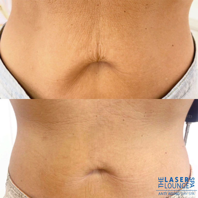 rf-microneedling-laser-lounge-estero-8