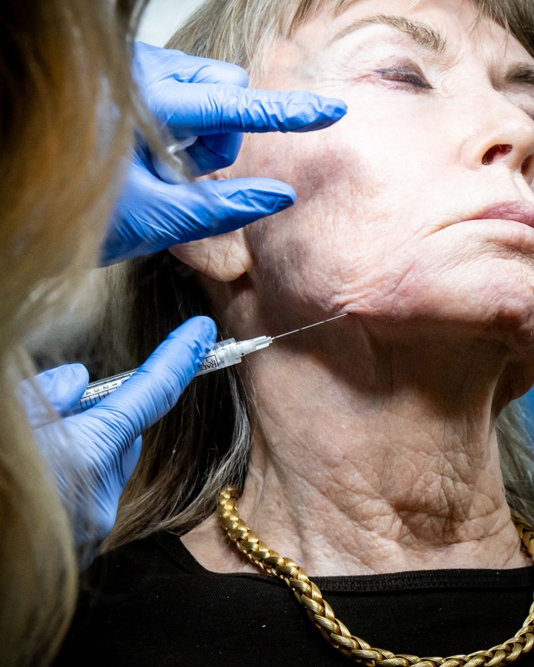 Neurotoxin treatment